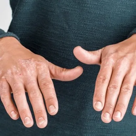 Inflammatory conditions